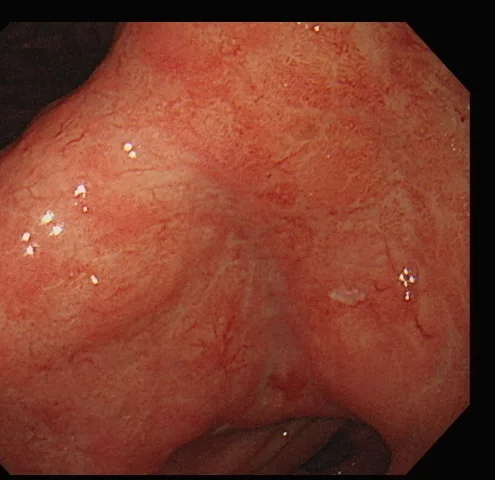 第二次胃鏡白光影像：胃角黏膜結節狀腫脹、皺襞變厚的病變