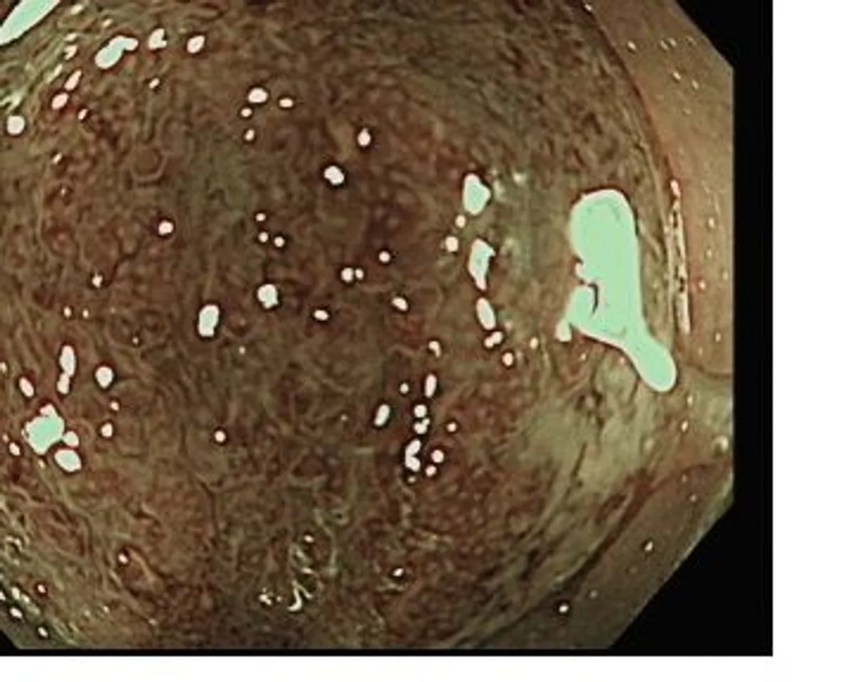 大腸鏡 NBI 窄頻影像：黏膜表面糜爛並覆著黏液