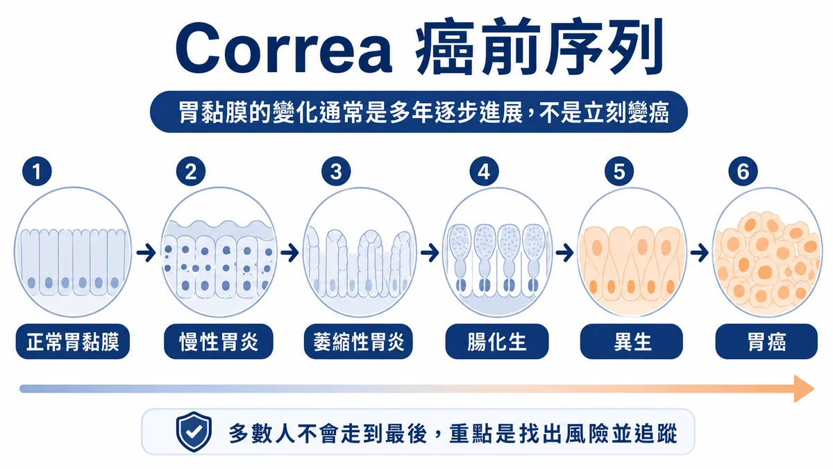 Correa 癌前序列示意：正常胃黏膜→慢性胃炎→萎縮性胃炎→腸化生→異生→胃癌，多以年為單位推進