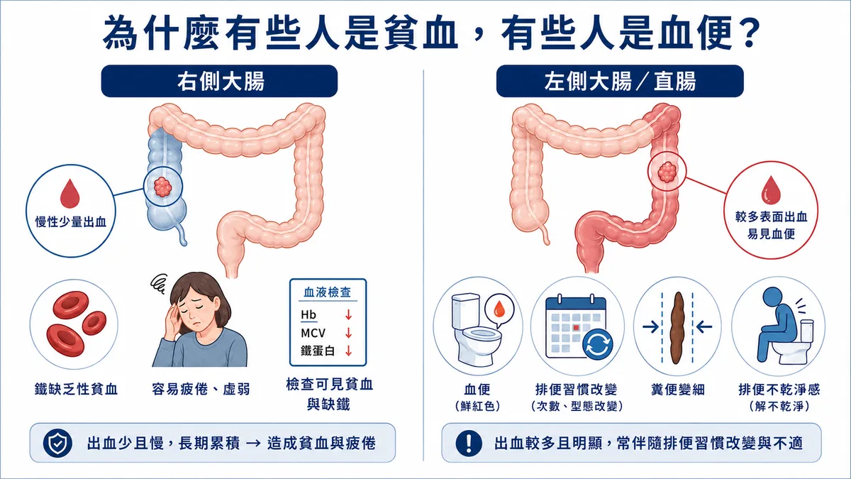 右側與左側大腸癌症狀差異示意：右側常以貧血、疲倦表現，左側較常見血便、排便習慣改變與糞便變細
