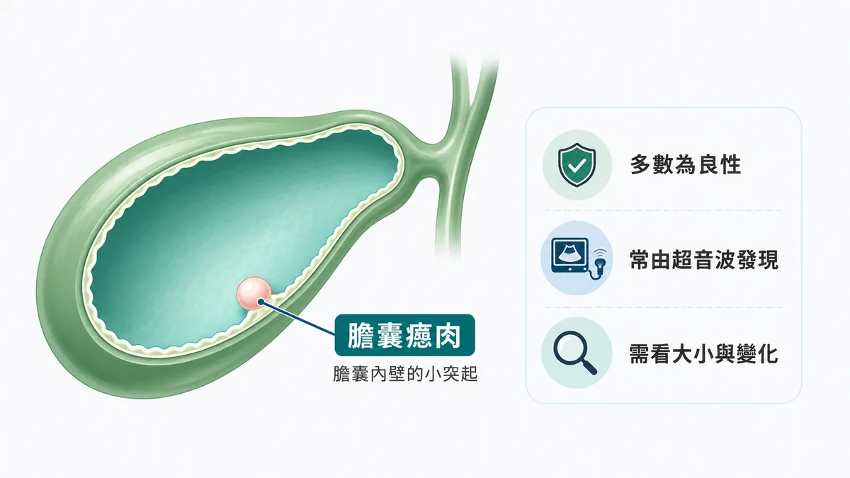 圖解膽囊瘜肉:膽囊內壁向腔內突起的小病灶示意