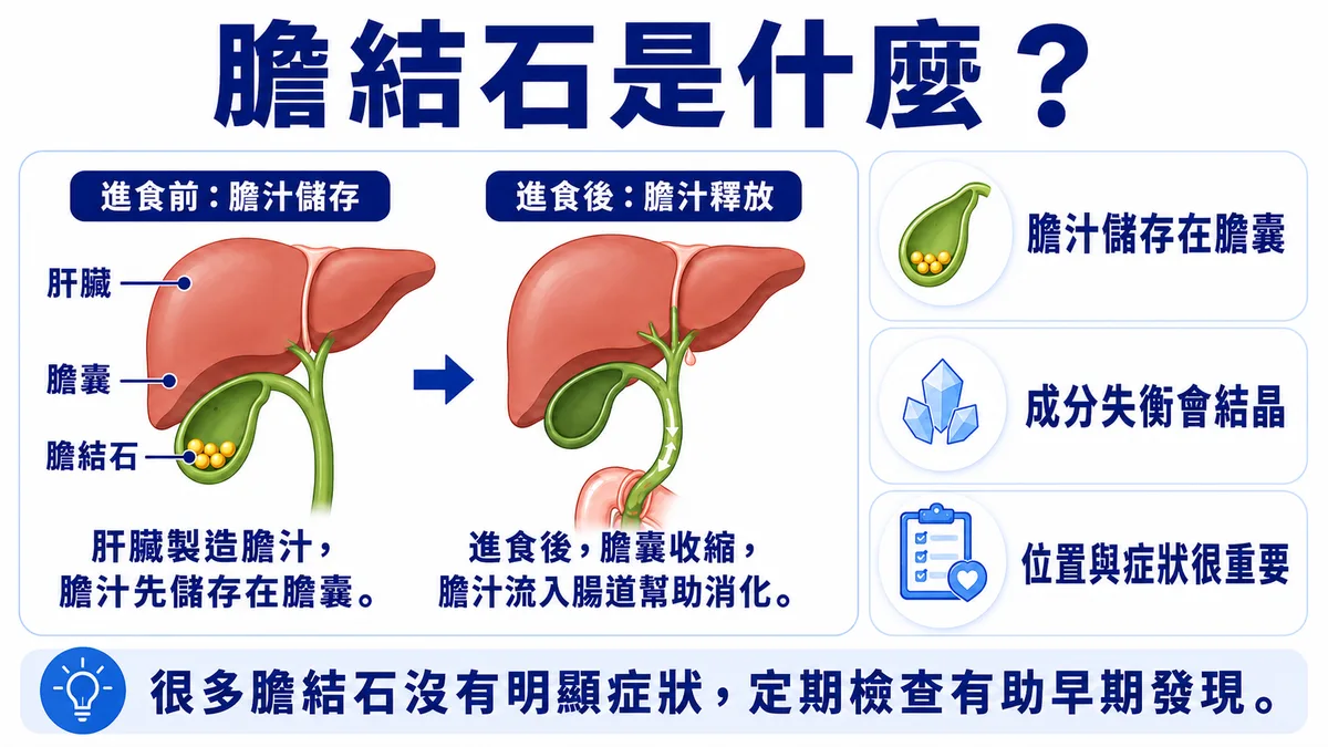 圖解膽結石是什麼：進食前膽汁儲存於膽囊、進食後釋放幫助消化，膽汁成分失衡會結晶形成膽結石