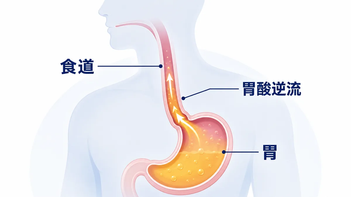 胃食道逆流機制示意圖：胃酸沿食道向上逆流至喉嚨
