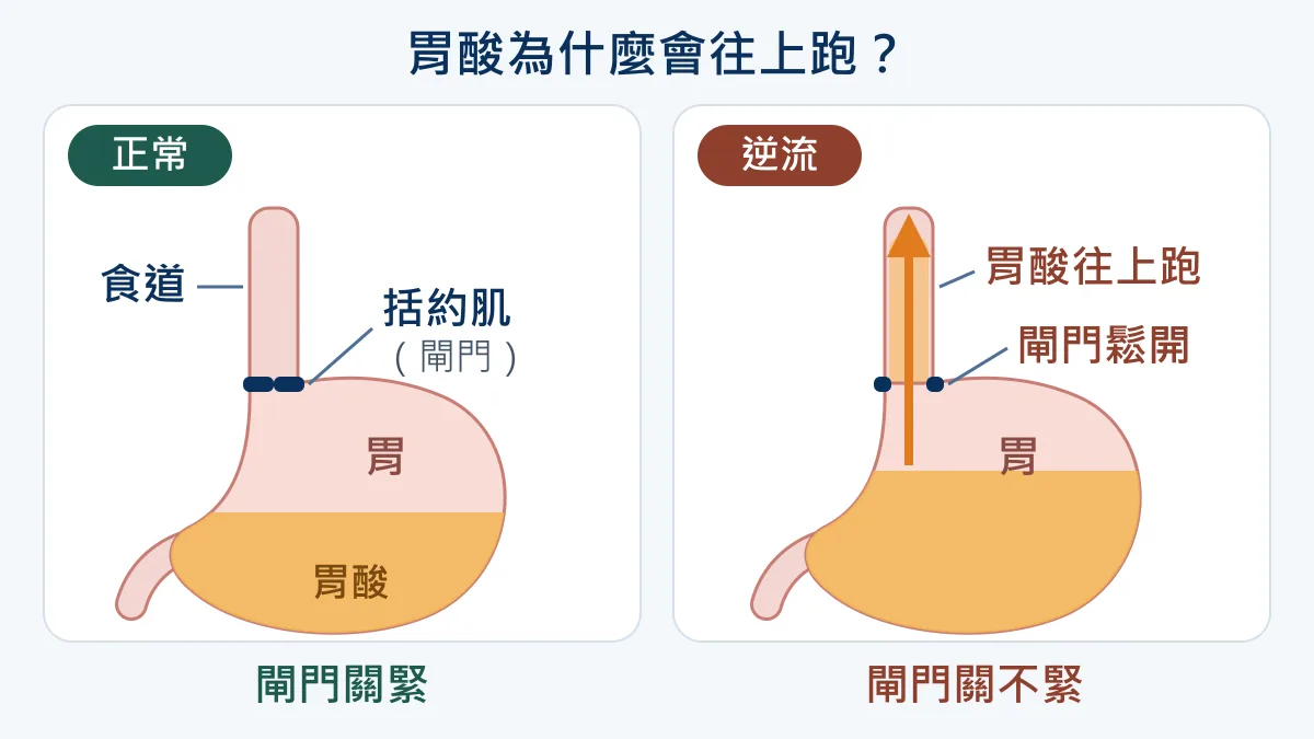 胃食道逆流機制對照圖：正常時下食道括約肌像閘門關緊，胃酸留在胃裡；胃食道逆流時閘門變鬆，胃酸往上跑進食道，造成火燒心、喉嚨卡卡
