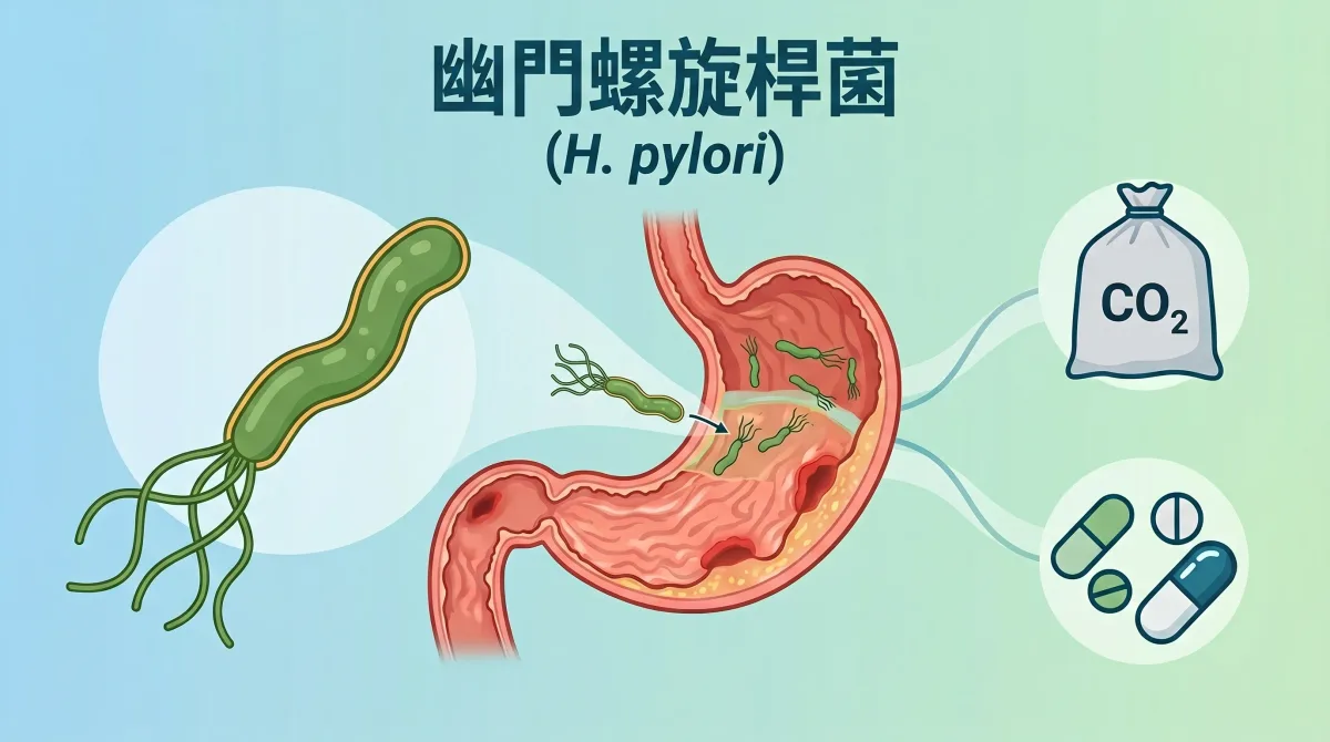 幽門螺旋桿菌（H. pylori）感染胃部、吹氣檢測與除菌藥物示意圖