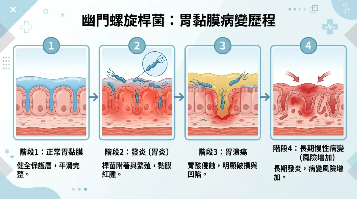 幽門螺旋桿菌感染造成胃黏膜從正常、發炎、胃潰瘍到長期慢性病變四階段示意圖