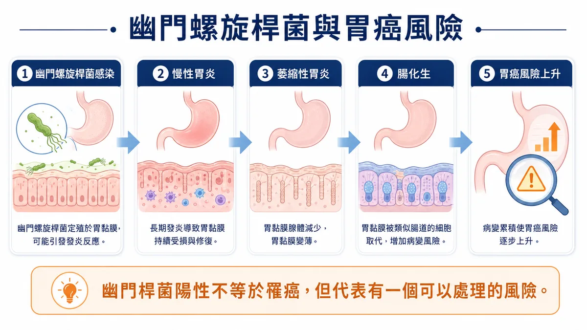 幽門螺旋桿菌導致胃癌的風險路徑：正常胃黏膜→慢性胃炎→萎縮性胃炎→腸化生→胃癌，除菌可在中途降低風險