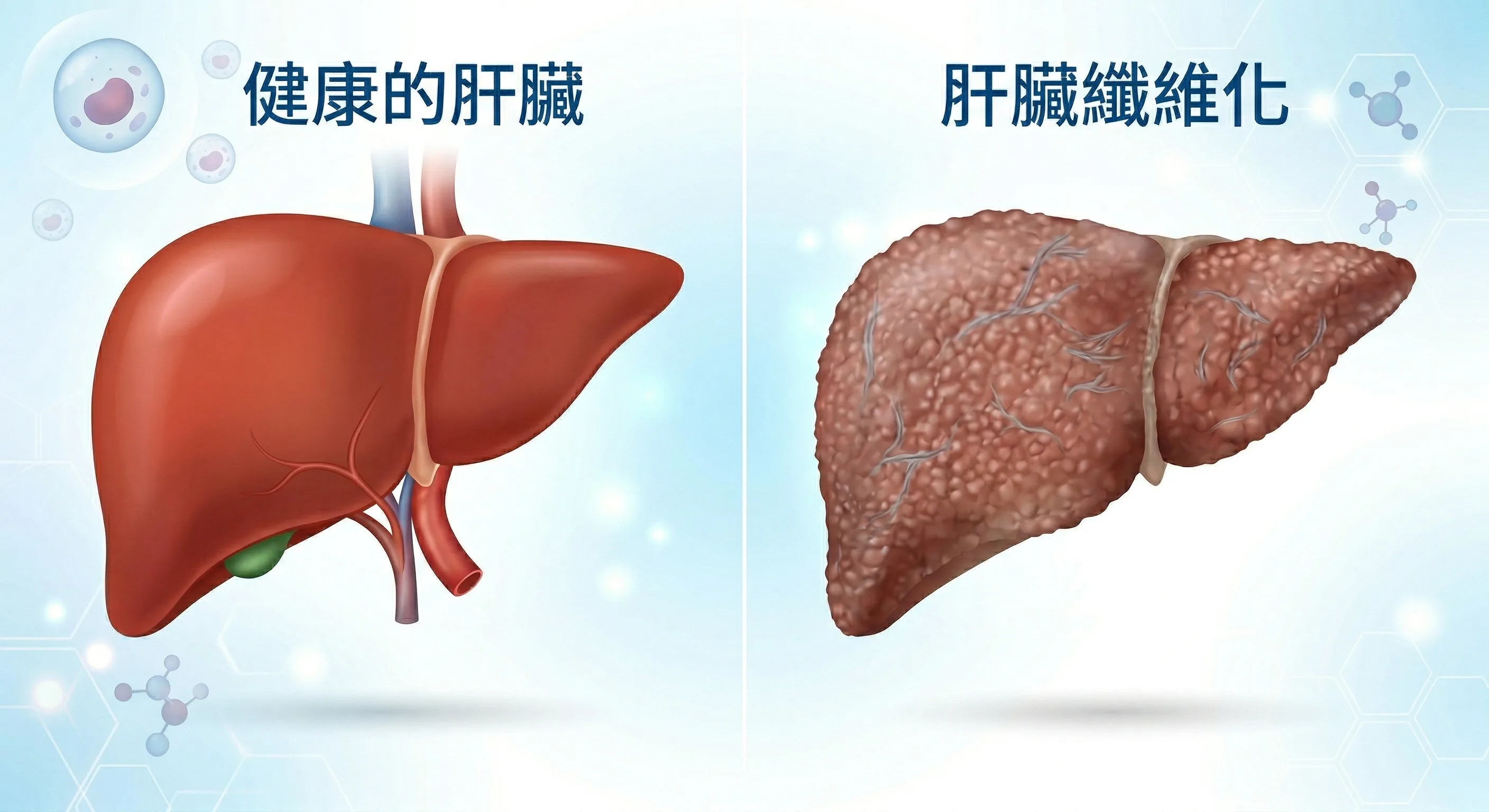 健康肝臟與肝纖維化肝臟的組織結構對比，顯示纖維組織逐漸取代正常肝細胞