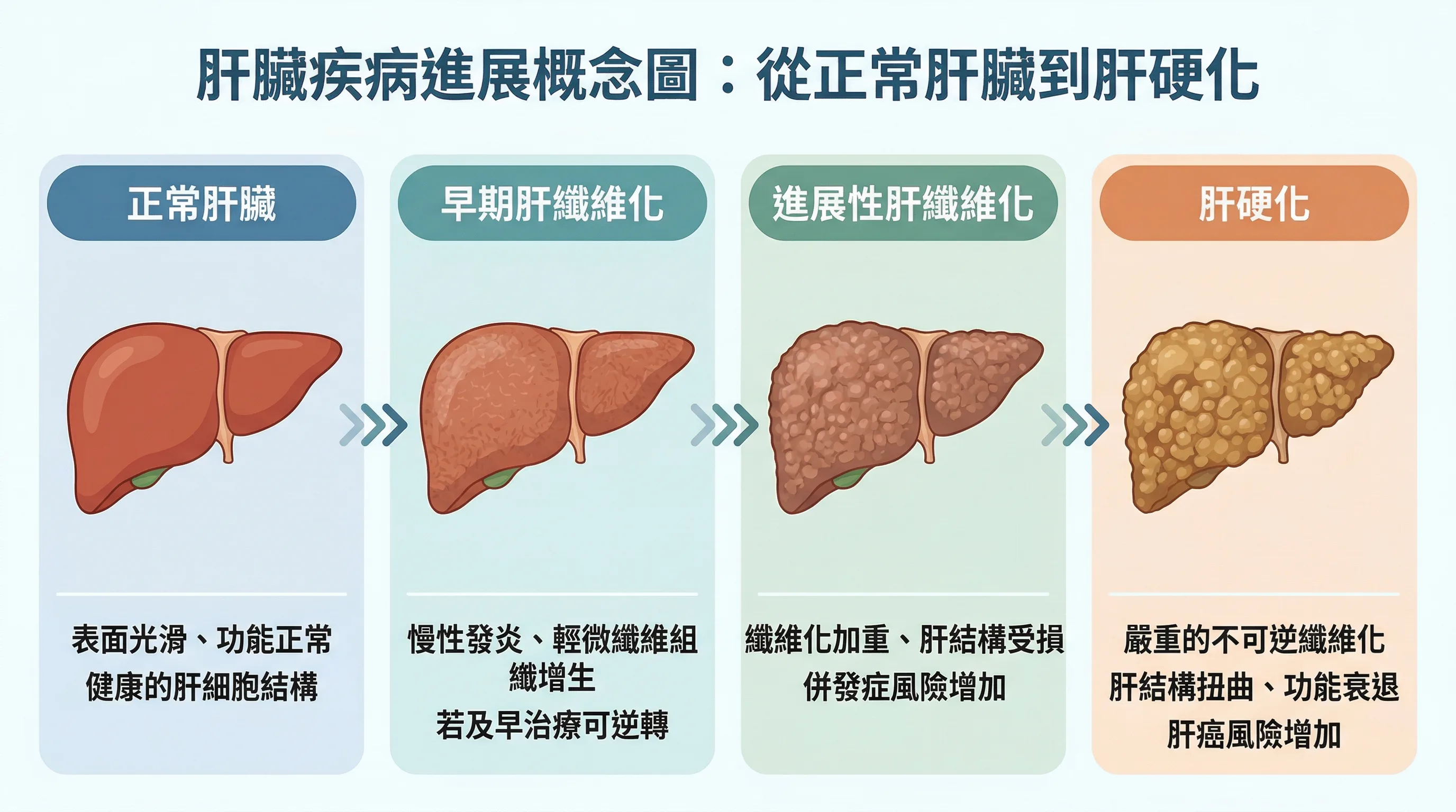 肝纖維化從輕度疤痕逐步進展到肝硬化的階段示意圖