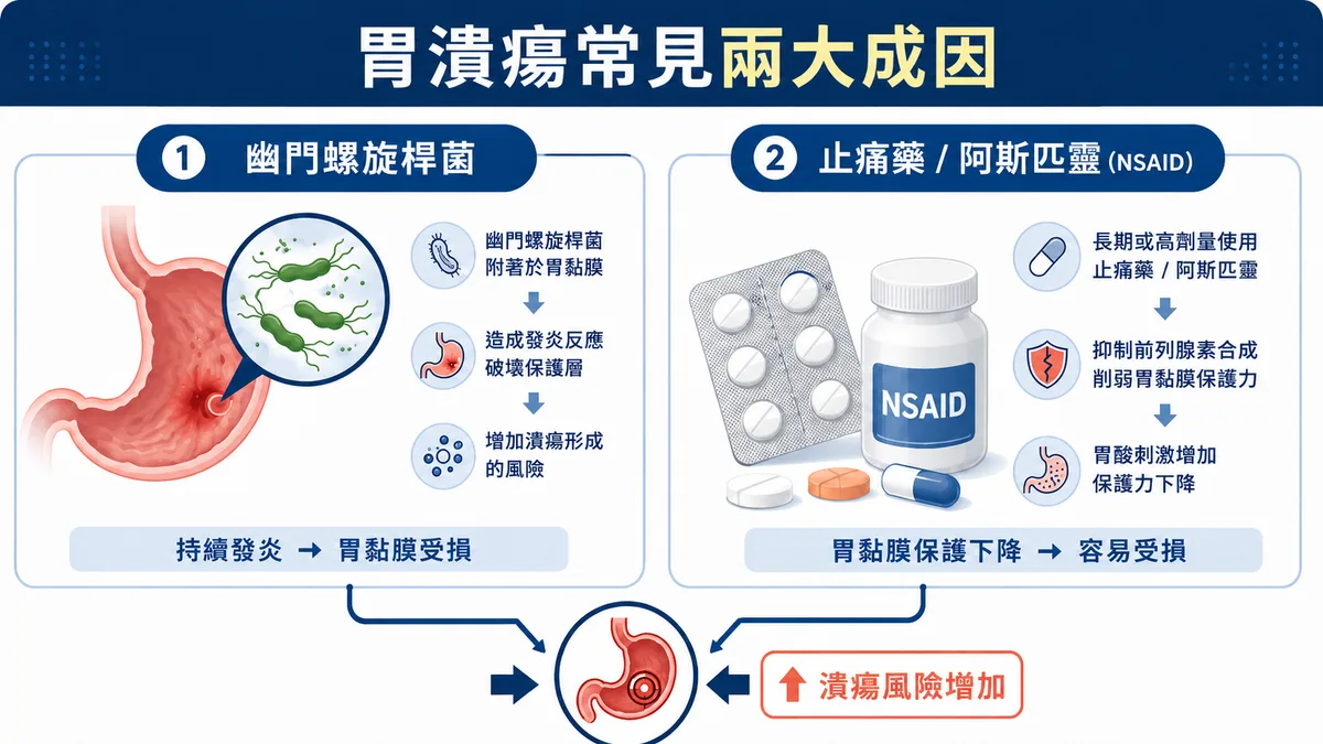 消化性潰瘍兩大主因示意：幽門螺旋桿菌長期感染破壞胃黏膜，與長期 NSAID 止痛藥／阿斯匹靈削弱保護機制